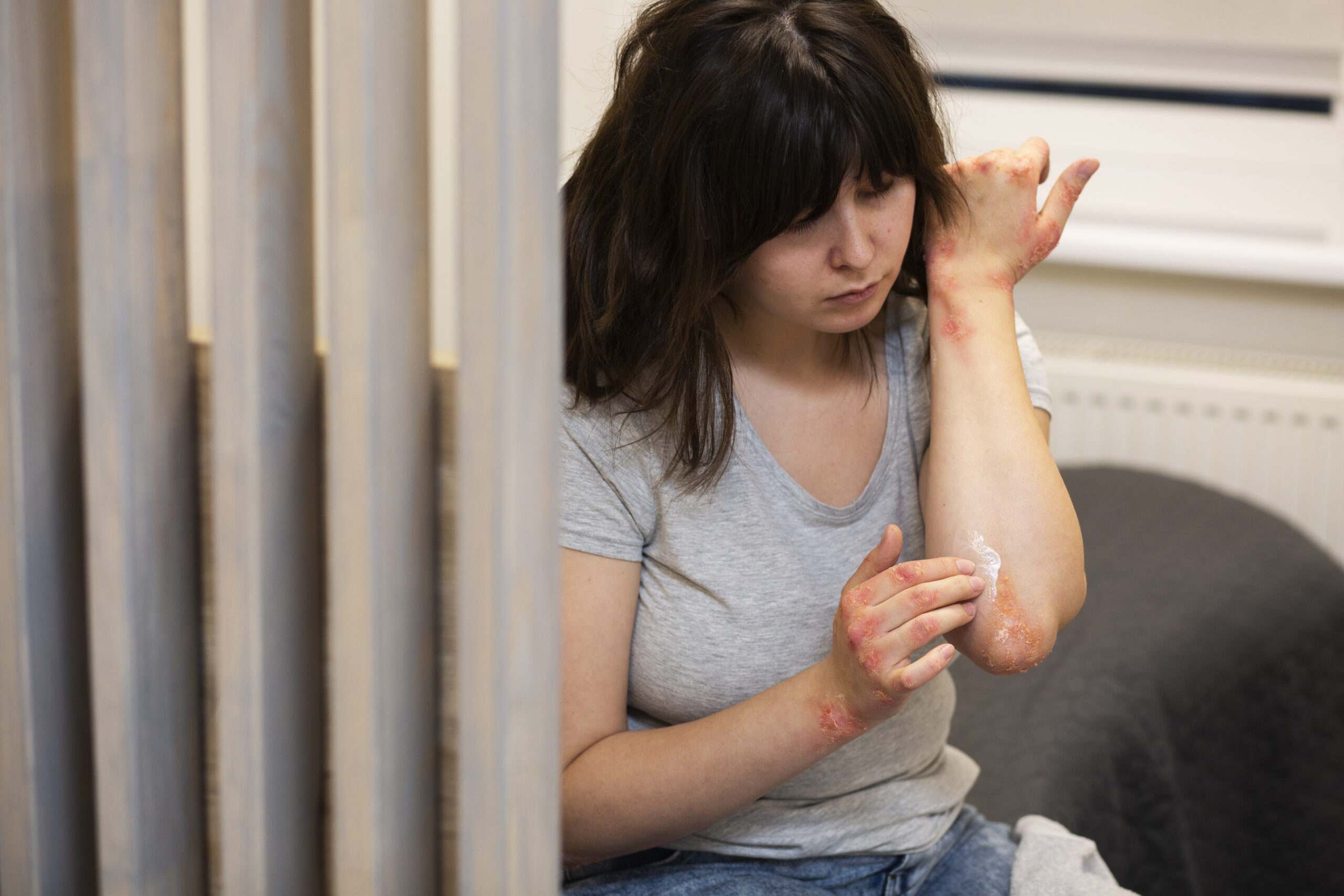 Chikungunya: Sintomas Intensos e Como Reconhecer a Doença Logo no Início